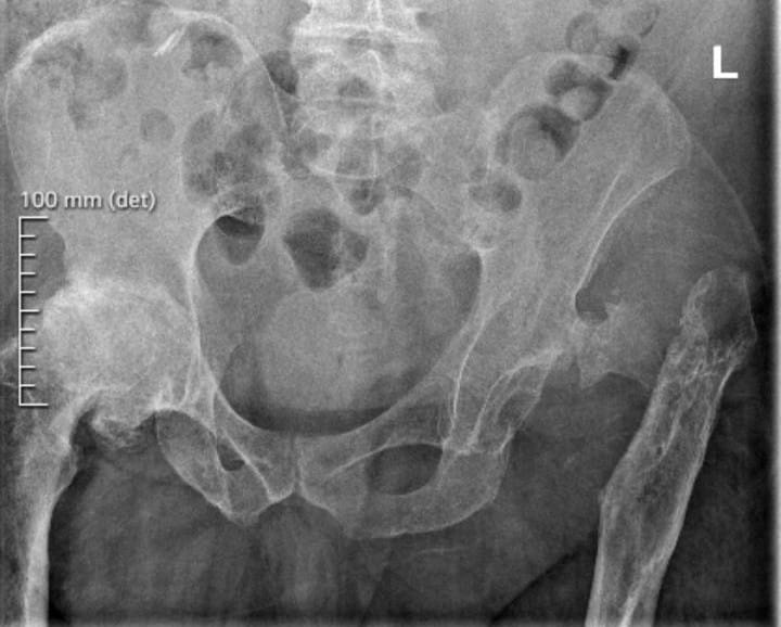 hip xray